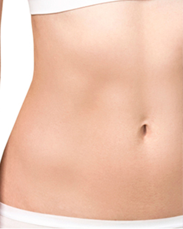 abdominoplastia-despues