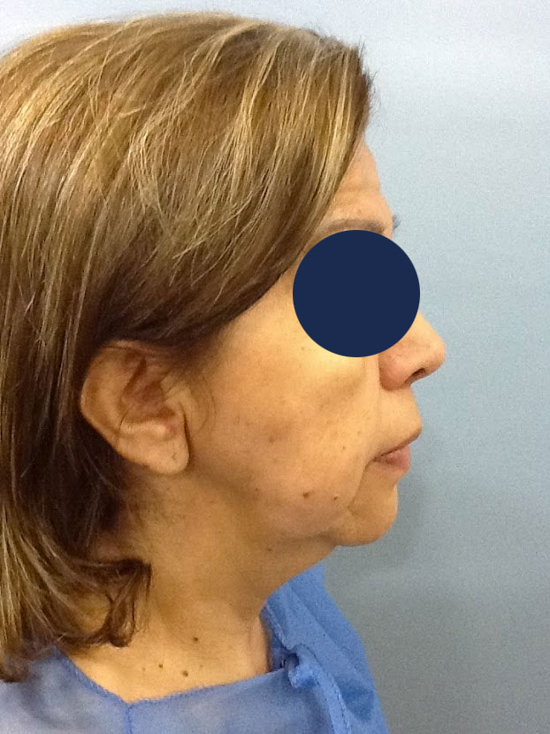 blefaroplastia-antes