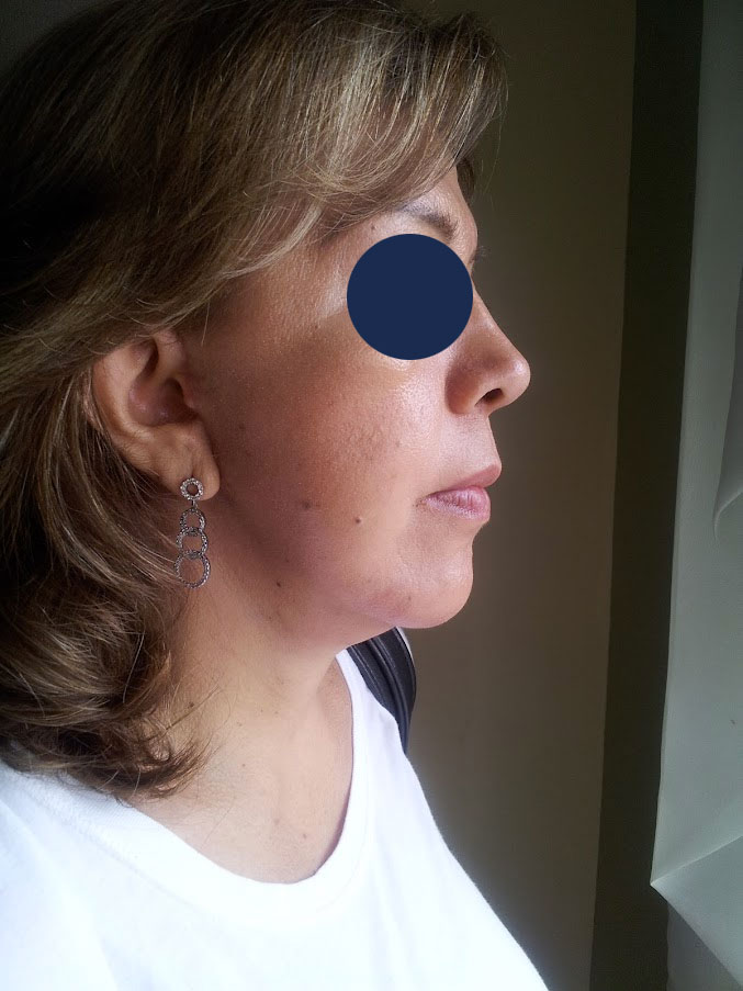 blefaroplastia-despues